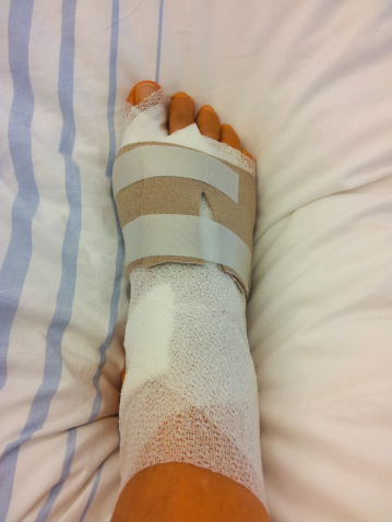Recovering from Foot Surgery and Exercise