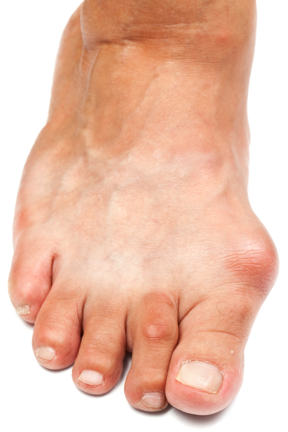 Foot Fitness Exercises for a Painful Bunion